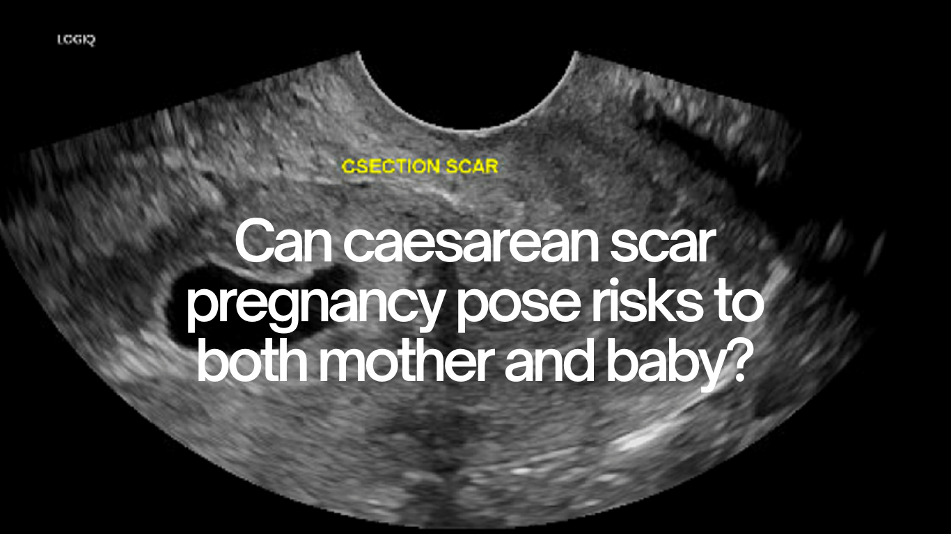 can-caesarean-scar-pregnancy-pose-risks-to-both-mother-and-baby